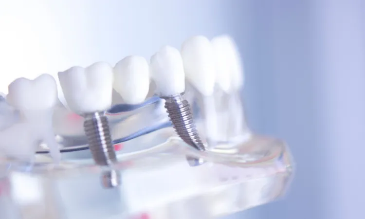 Model of dental implants with crowns mounted on implant posts